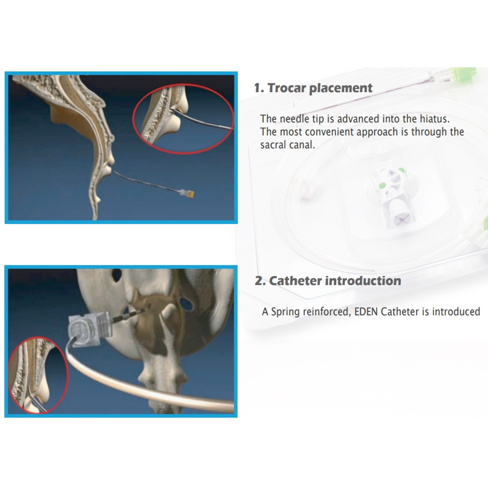 Epidural Catheter System